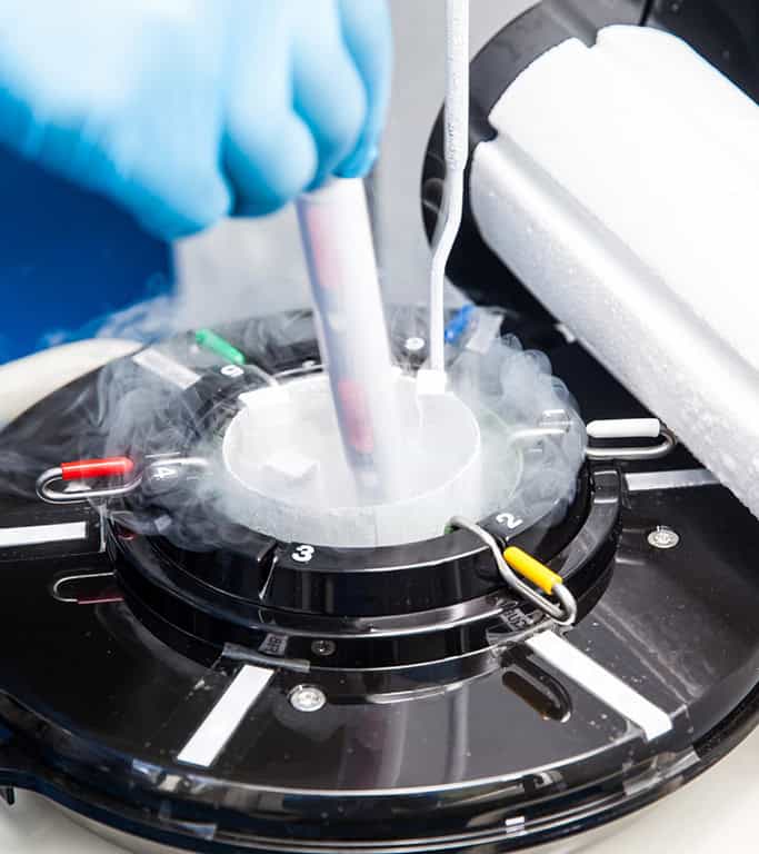 How Does Sperm Freezing Work for Future IVF?