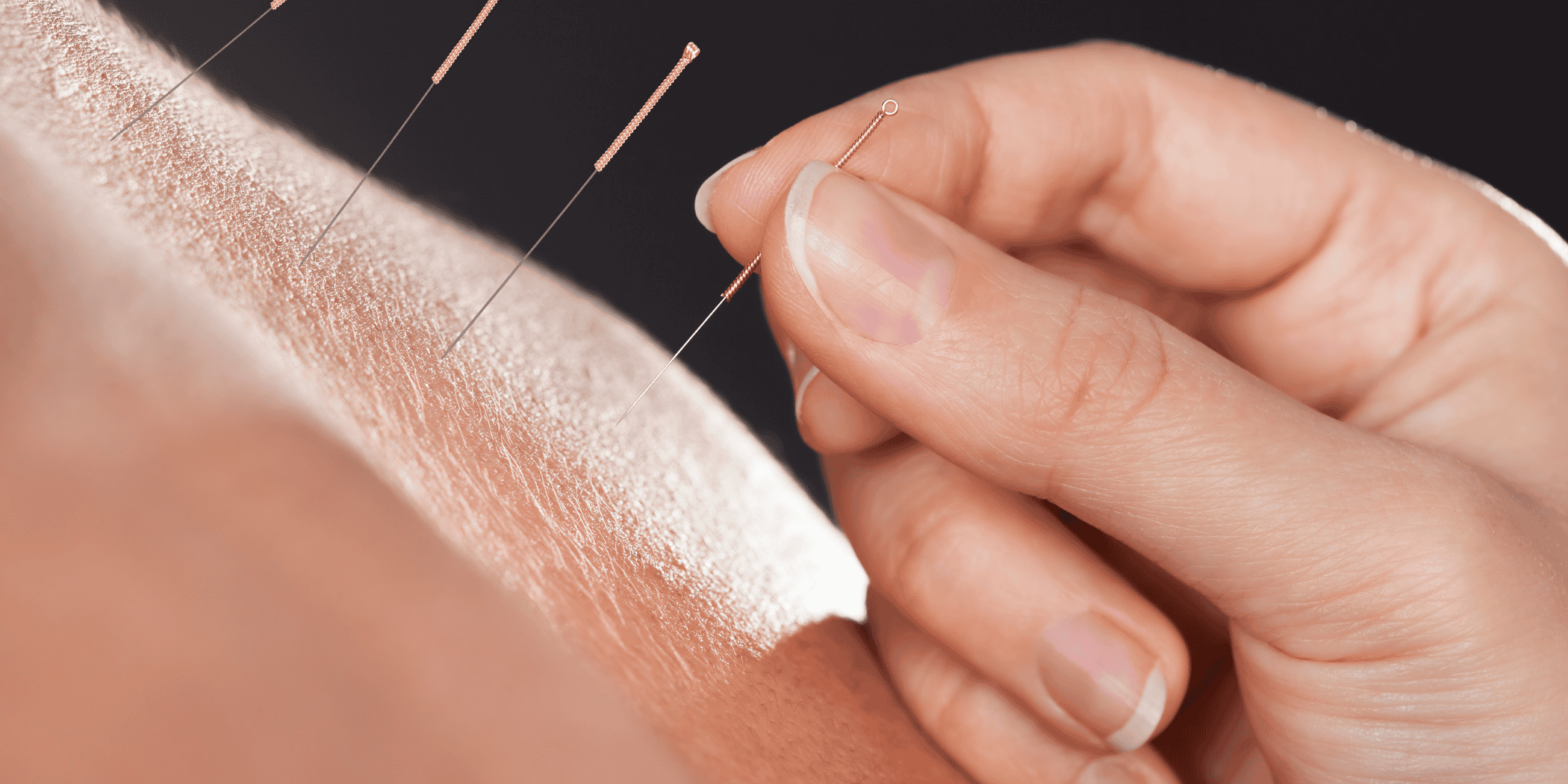 The Role of Acupuncture in Fertility Treatments