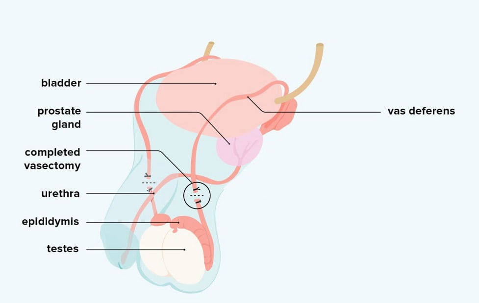 Comparing Tubectomy and Vasectomy: Which Option is Right?