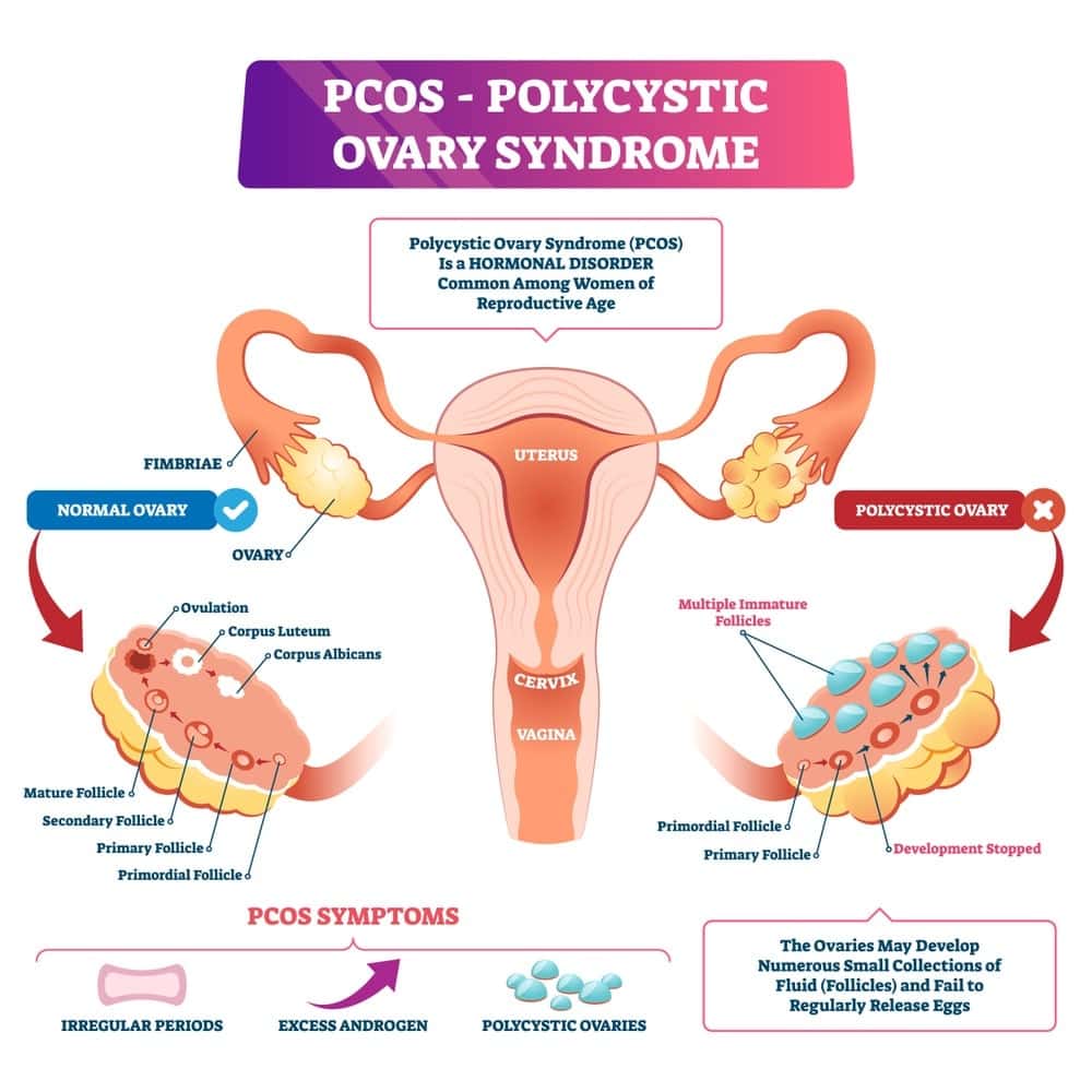 PCOS and Pregnancy: A Complete Guide to Conceiving with Polycystic Ovaries